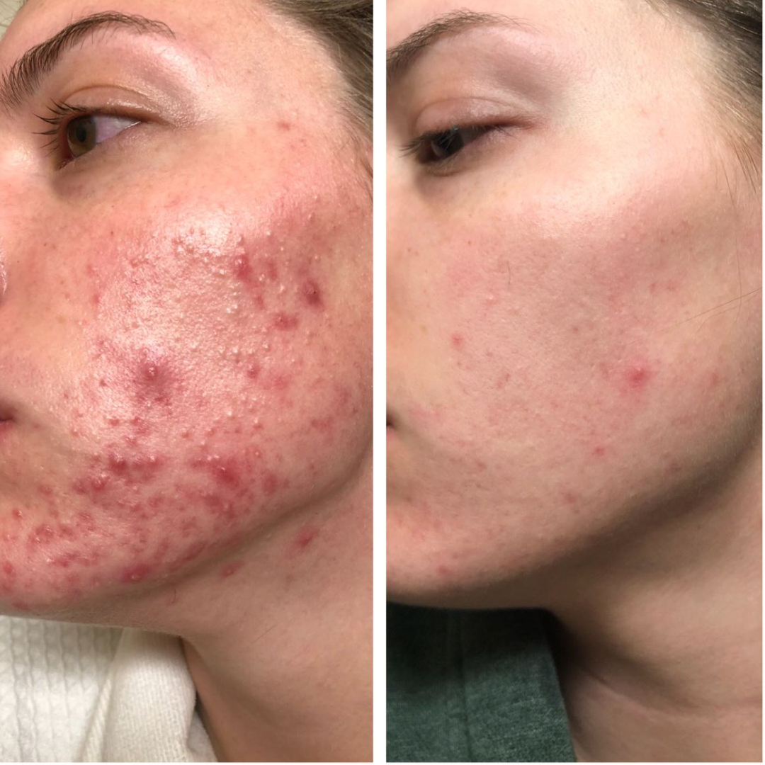 dr. Melaxin  l Ampolla exfoliante de arroz radiante™