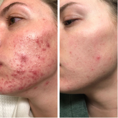 dr. Melaxin  l Ampolla exfoliante de arroz radiante™